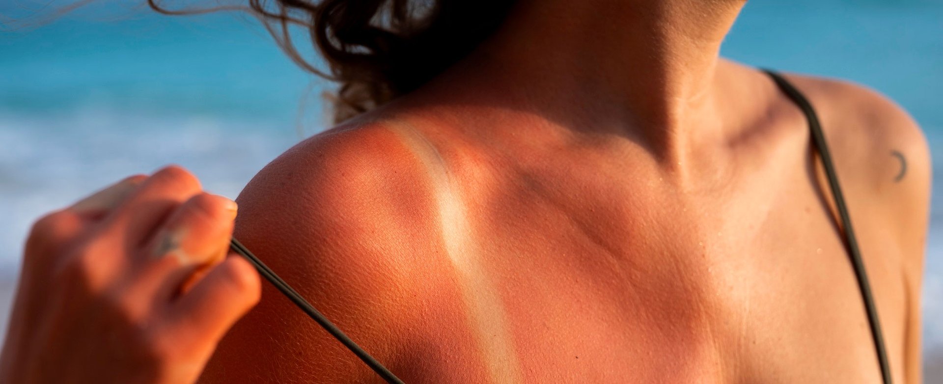 Co Pomaha Na Spaleni Od Slunce