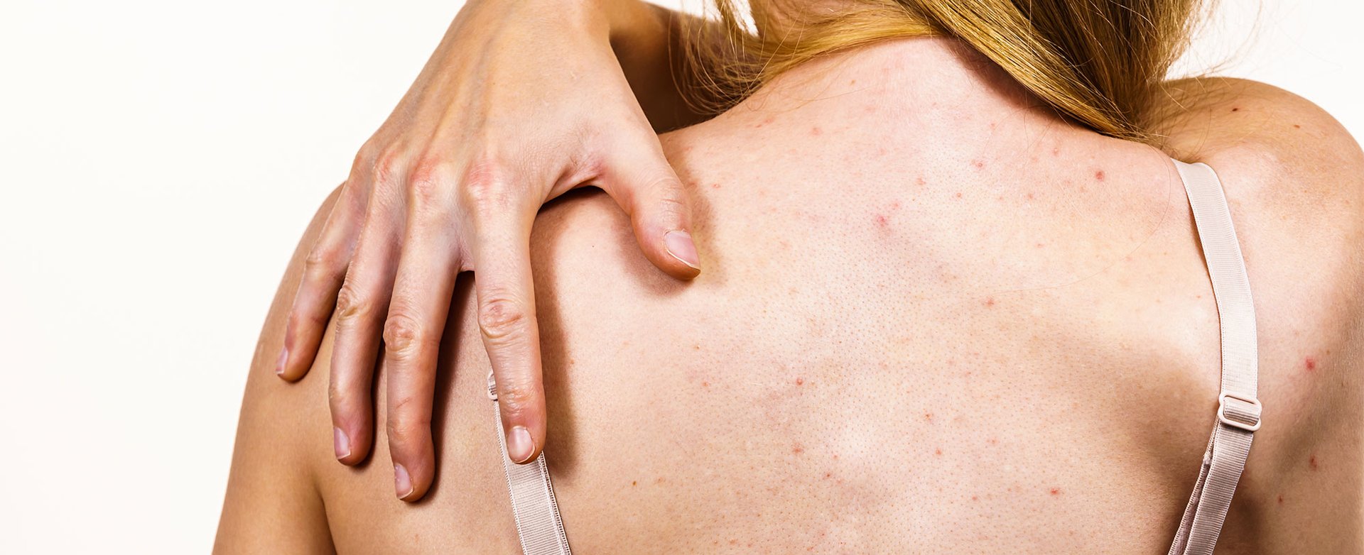 Jak Se Zbavit Akne Na Zadech