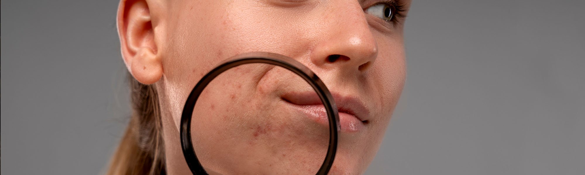 Acne Scars